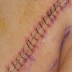 Réflexion autour de la suture chirurgicale