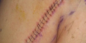 Lire la suite à propos de l’article Réflexion autour de la suture chirurgicale